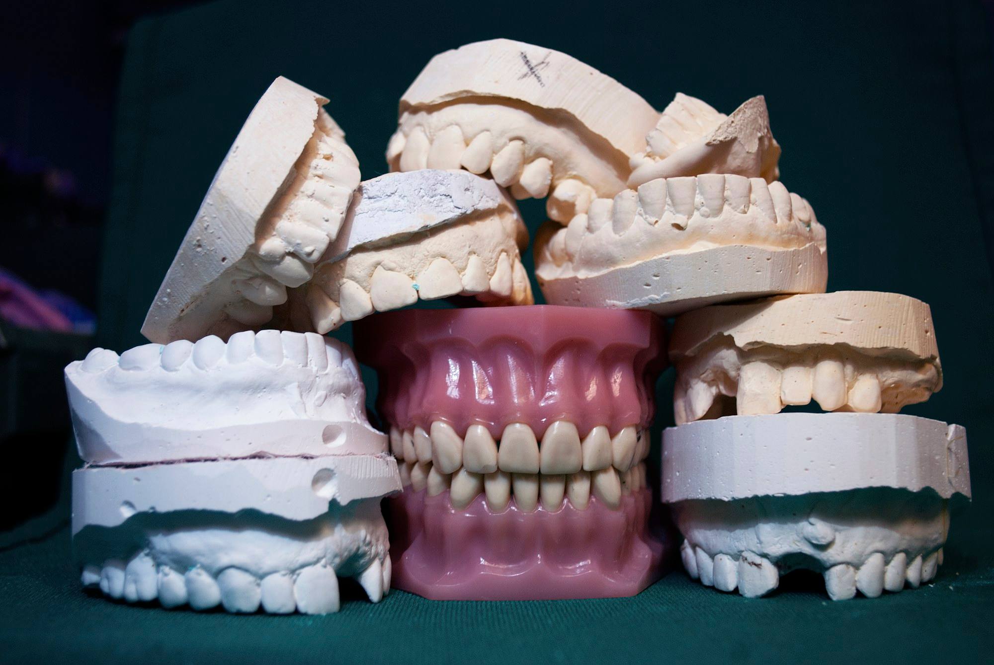 Modelos dentales de escayola apilados