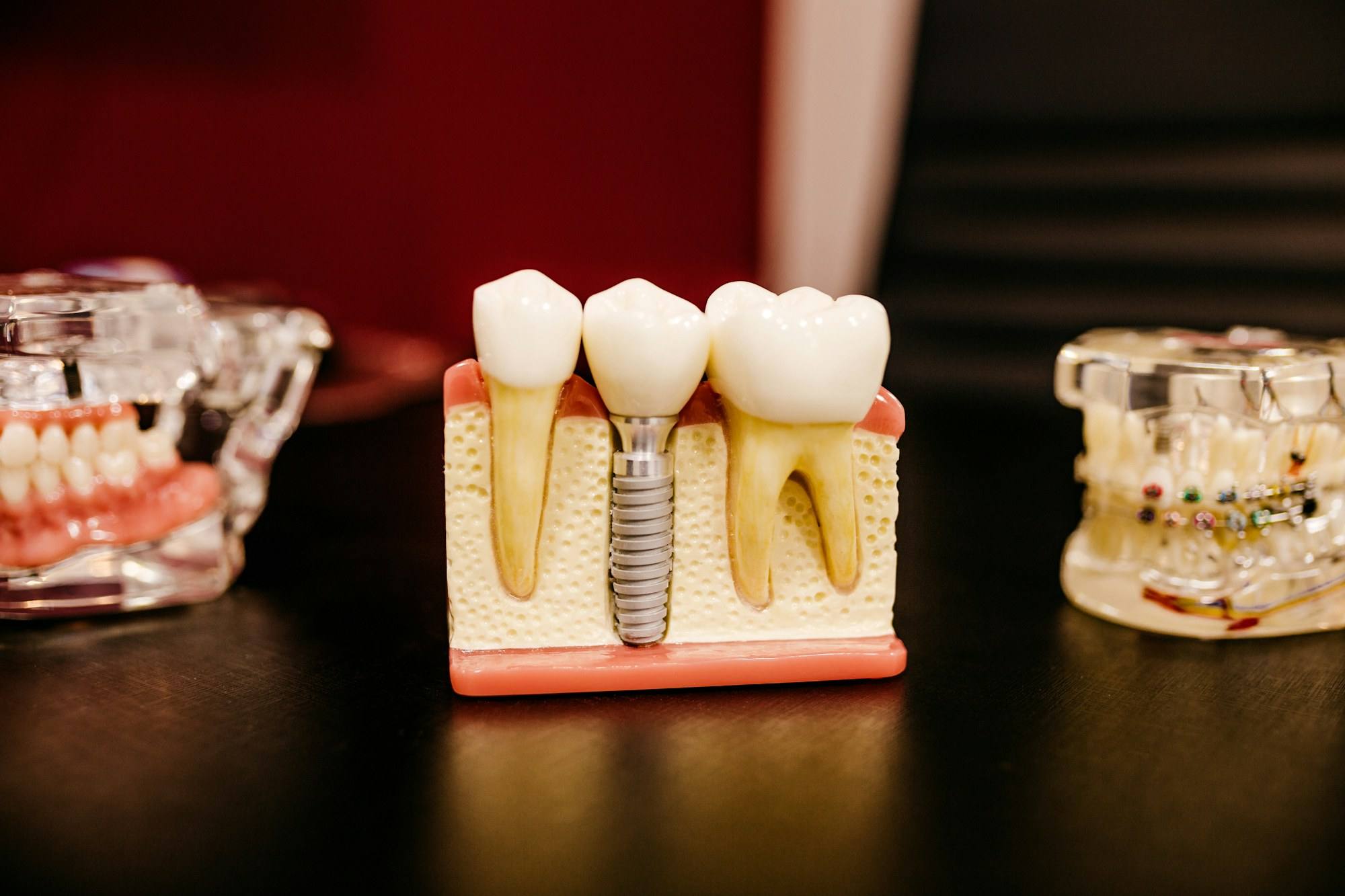 Modelos de implantes dentales sobre una mesa